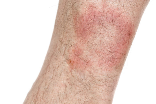Symptom of Lyme Disease, Circular Expanding Rash, Erythema Migra