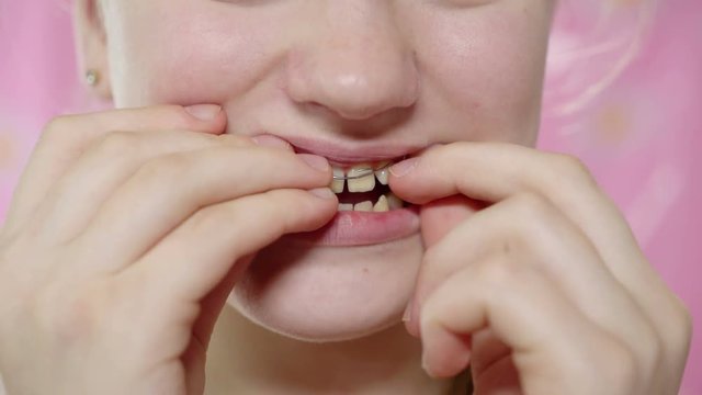  Teenage girl putting dental retainer on teeth closeup