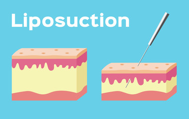 Liposuction before and after , fat , cosmetic . step of Liposuction
