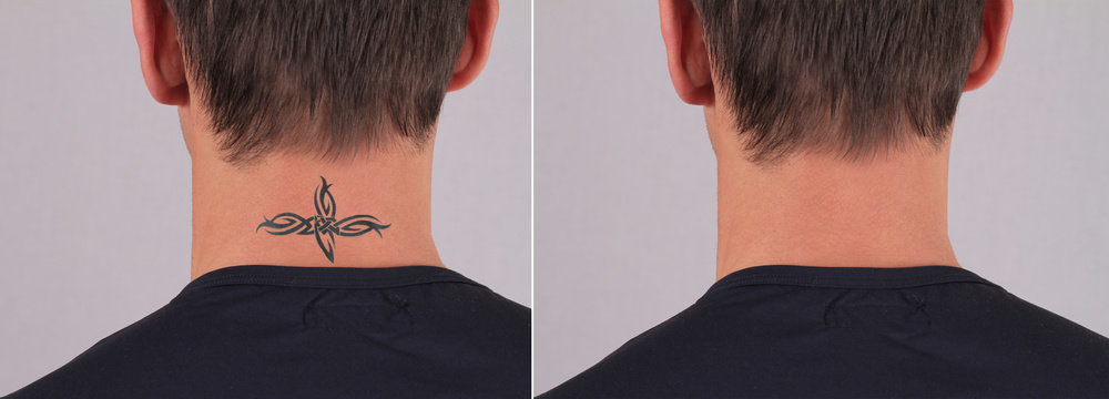 Man Before And After Laser Tattoo Removal Treatment