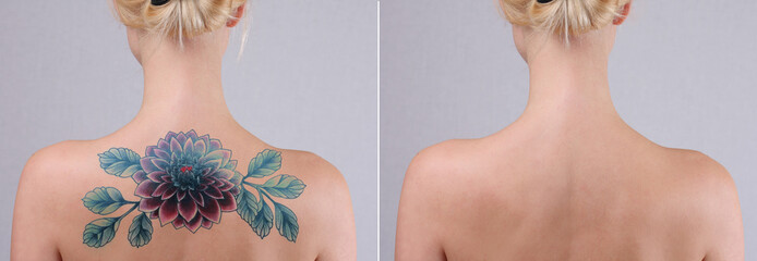 Laser tattoo removal before and after. Beautiful young woman with tattoo on her back - obrazy, fototapety, plakaty