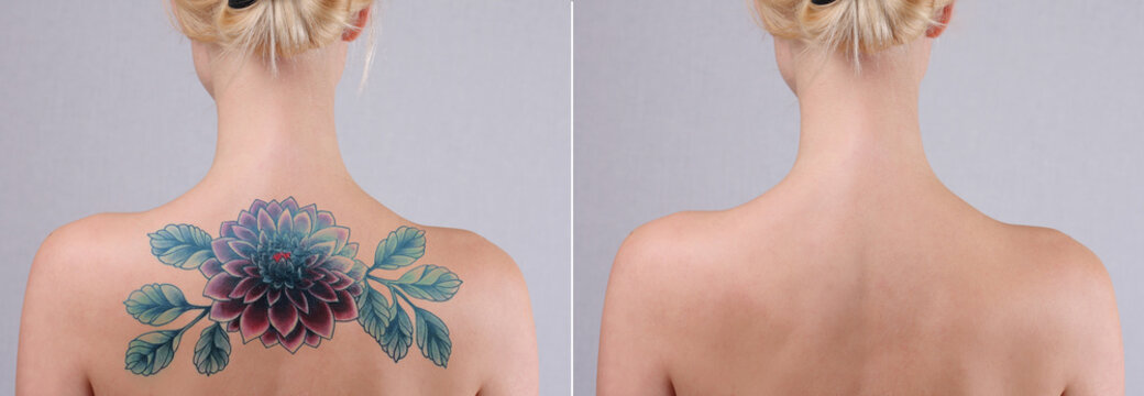 Laser tattoo removal before and after. Beautiful young woman with tattoo on her back