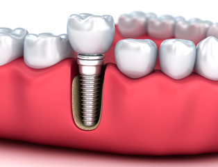 Fototapeta na wymiar Tooth human implant, Medically accurate 3D illustration white style