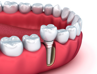Fototapeta na wymiar Tooth human implant, Medically accurate 3D illustration white style