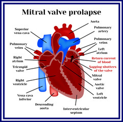 Heart structure. Mitral valve prolapse. Cardiac pathology.