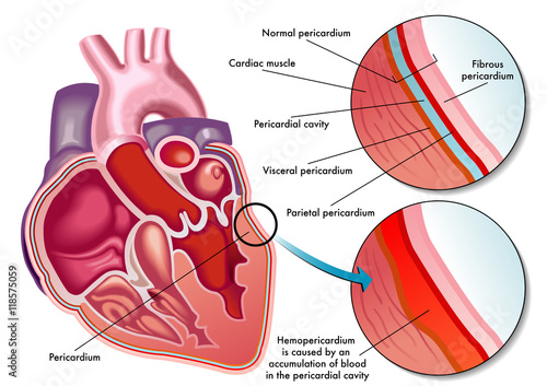 "hemopericardium" Stock Image And Royalty-free Vector Files On Fotolia ...