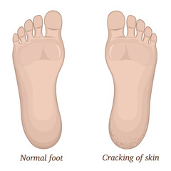 Illustration of healthy feet and feet with cracks on the heel