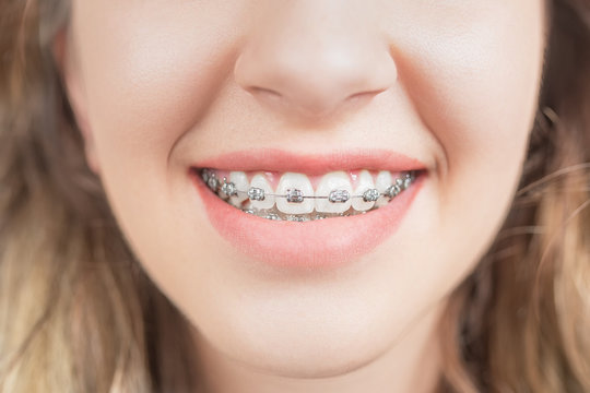 Smiling Woman with Teeth braces