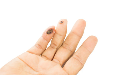 blisters on finger caused by electric shock