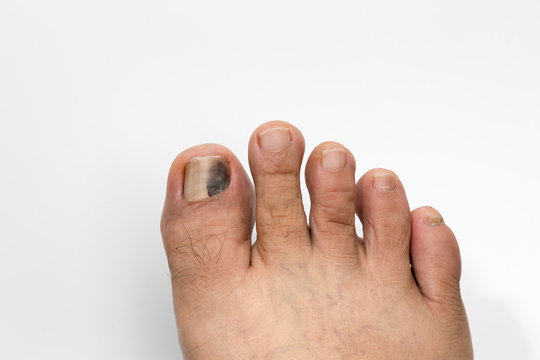 Black And Bruised Toenail On White Background