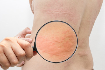 Women with allergies, symptoms of urticaria,Magnifier