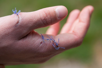 points de suture