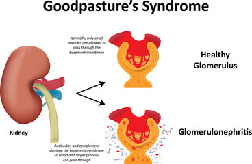 Goodpasture's Syndrome