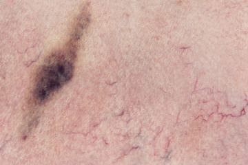 Human skin  with hematoma, vascular problems, couperose