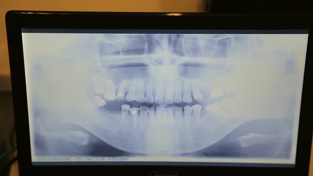 Computer screen shows a panoramic x-ray image of teeth and jaw.