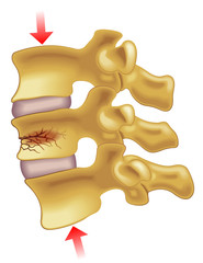 vertebral compression fracture - obrazy, fototapety, plakaty