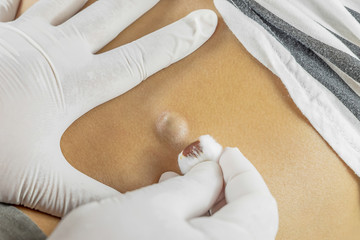 Doctor Diagnosis of the Sebaceous on Woman's Back