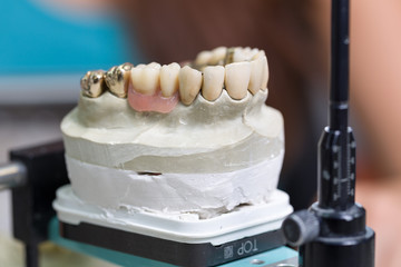 Zahnersatz im Dentallabor
