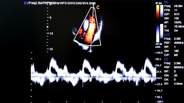 Modern echocardiography (ultrasound) machine monitor. Colour image. New hospitl equipment for a better diagnostics. Four Chambers View, B/BC Mode
