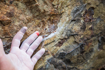 Injured hand 