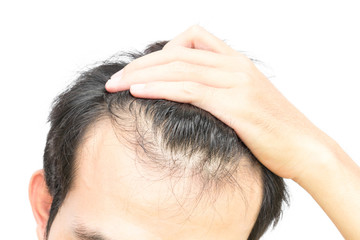 Fototapeta premium Closeup young man serious hair loss problem for hair loss concept