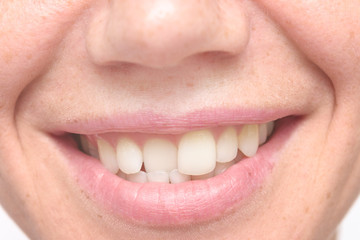 Fototapeta premium woman crooked teeth