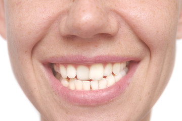 woman crooked teeth