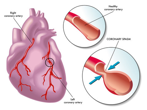 Coronary Artery Spasm