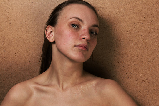 Closeup girl portrait with a scar on a clavicle after operation. Surgery concept.