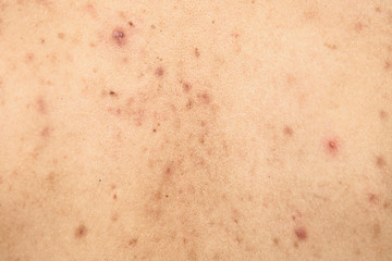 Fototapeta premium Boy with problematic skin and acne scars in the back