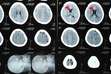 images from a computerized tomography of the brain