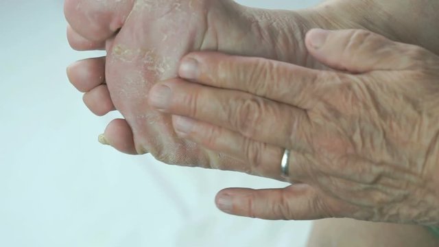Fungus infection on nails of woman's foot