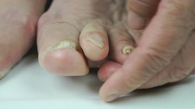 Woman's feet has fungal infections of toenails