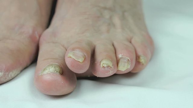 Onychomycosis. Fungal infection of toenails