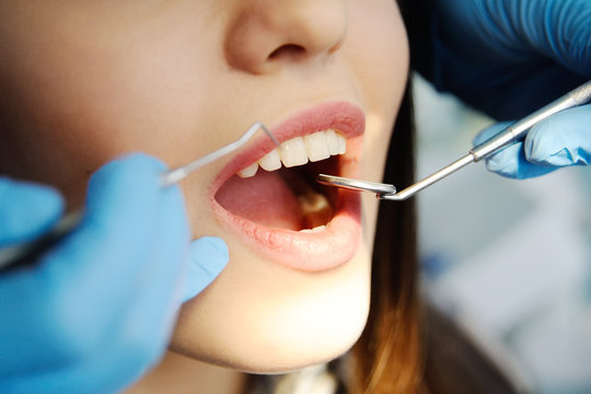 teeth of a beautiful girl closeup. girl at the dentist