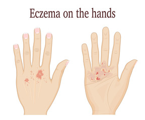 Obraz premium Eczema on a palm and on the back of hand