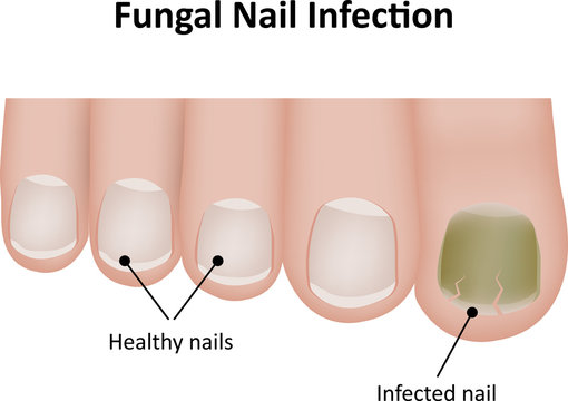 Fungal Nail Infection Diagram Stock Vector | Adobe Stock