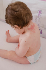  Roseola infantum