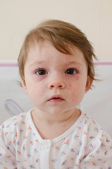  Roseola infantum