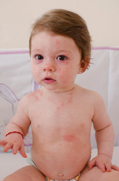  Roseola infantum