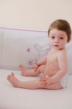  Roseola infantum