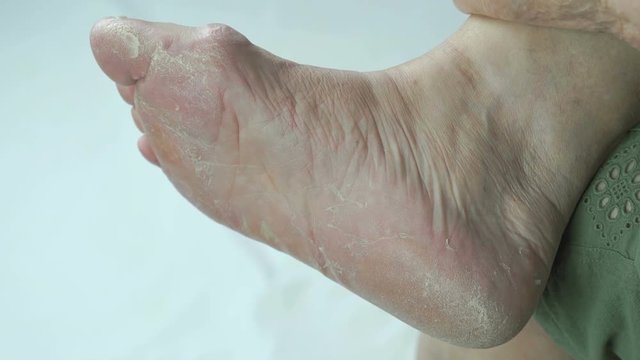 Woman's feet with fungal infections of toenails