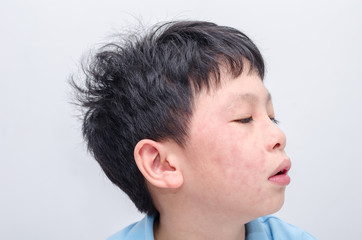 Closeup face of young asian boy with rash from allergy