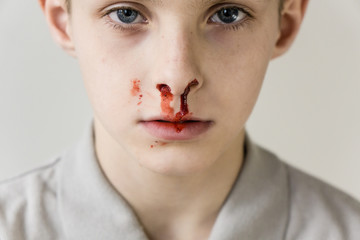 Boy with Nose Bleed Staring Blankly at Camera