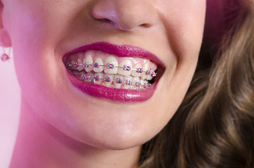 Closeup of woman white teeth with pink braces