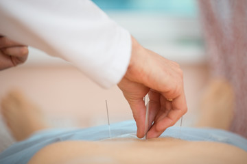 Photo of acupuncture treatments, placement of medical needles on the patient, close-ups