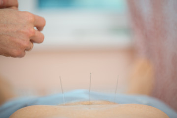 Photo of acupuncture treatments, placement of medical needles on the patient, close-ups