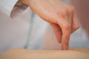 Obraz na płótnie Canvas Photo of acupuncture treatments, placement of medical needles on the patient, close-ups