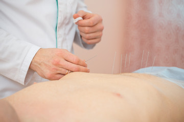 Photo of acupuncture treatments, placement of medical needles on the patient, close-ups
