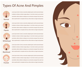 Types of acne and pimples